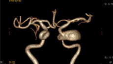 广西首例“Pipeline（密网支架）治疗颅内巨大动脉瘤”手术在一附院施行并获成功