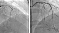 三支冠脉复杂病变濒临绝境 瑞康心内科专家妙手回春