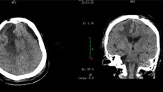 一附院外六科成功救治1例颅底廉旁巨大脑肿瘤患者
