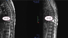 警民密切协作，一附院积极救治截瘫服刑患者