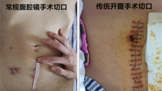 一附院仙葫院区胃肠肛门外科成功完成首例直肠癌腹腔镜NOSES手术