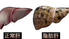 双镜联合活捉肝吸虫，再吃鱼生wéi~