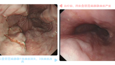 内镜+介入治疗食管静脉曲张