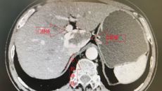 从容、细致迎接挑战 摘除肝脏中的“定时炸弹”