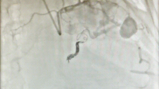 79岁老人突发晕厥险些丧命，全因心脏畸形血管破裂......