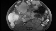 患癌10年，生存期仅剩3个月，残酷局面还有望扭转吗？