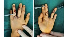 附属瑞康医院：姐弟俩最开心的事——我们粘连的手指终于打开啦！